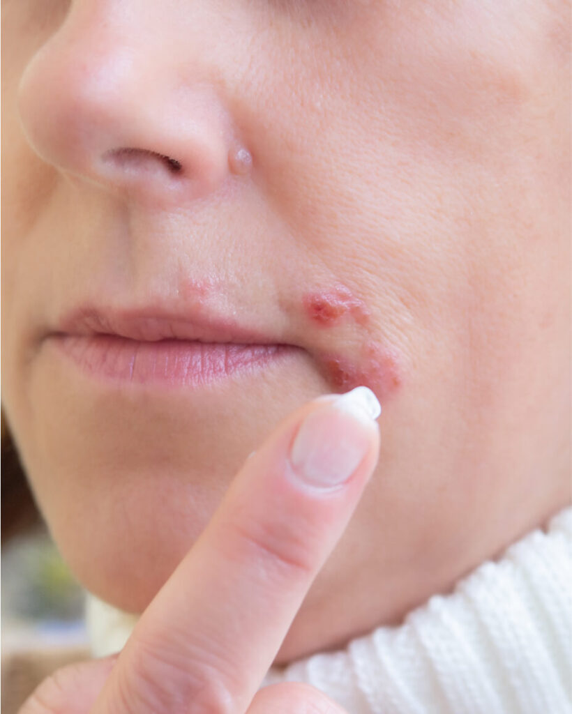 herpes-on-the-lips-part-of-a-woman-s-face-with-fi-2025-02-02-20-23-49-utc (3)