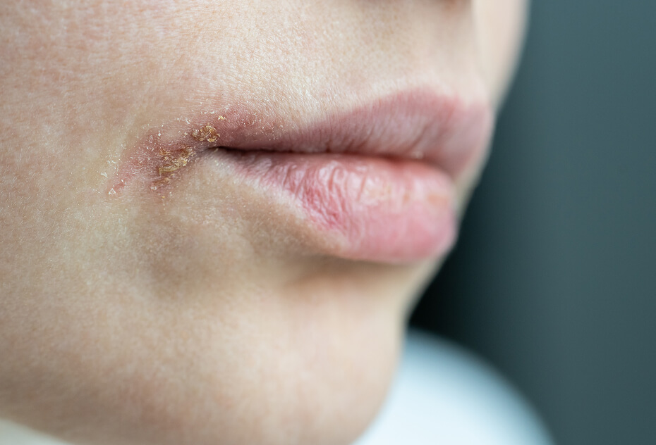 herpes