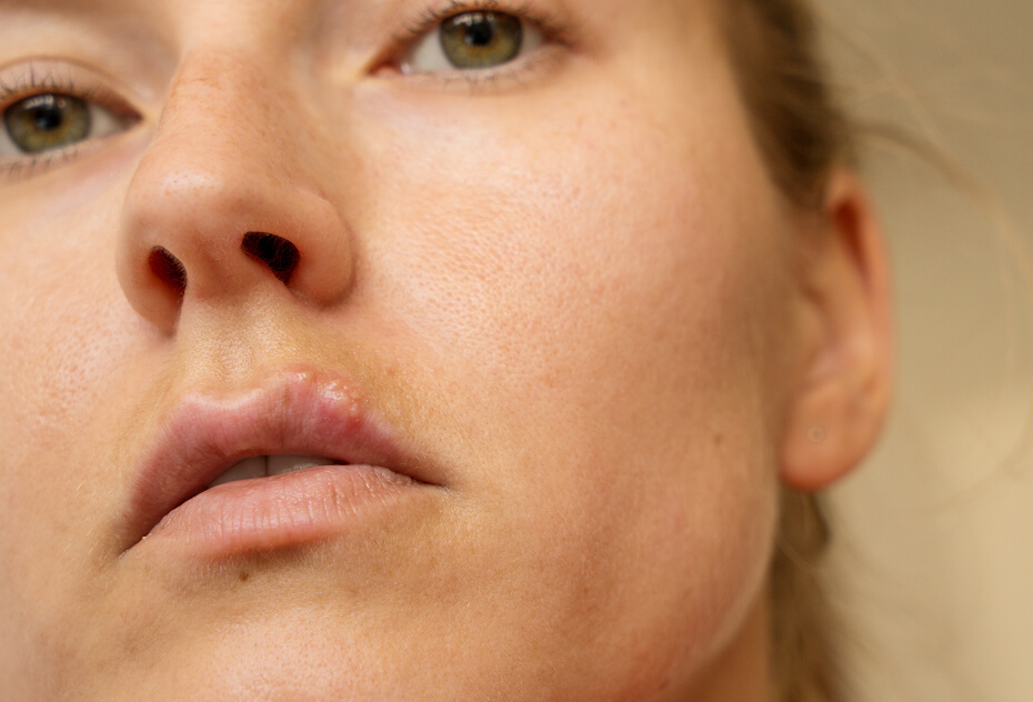 cold sores woman