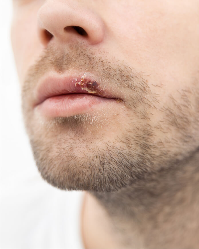 young-man-suffering-from-herpes-on-his-mouth-2024-09-16-17-54-29-utc (2)